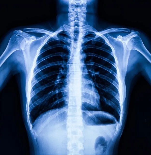Illustrative image for interstitial lung disease