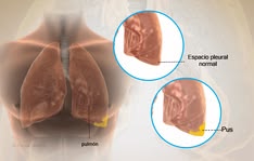 Diagram of the pleural space showing a normal pleura and pleural infection